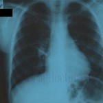 Рентген легких при перисциссурите